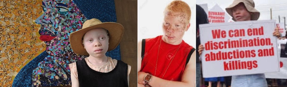Embracing albinism- people with albenism